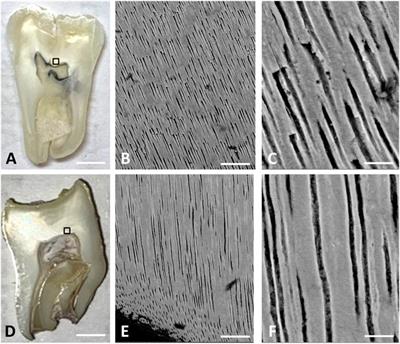 Enamel and dentin in Enamel renal syndrome: A confocal Raman microscopy view